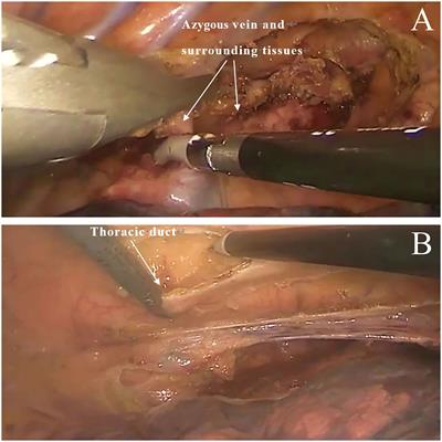 Efficacy of modified thoraco-laparoscopic Ivor-Lewis versus traditional thoraco-laparoscopic Ivor-Lewis for esophageal cancer: Propensity score-matched analysis